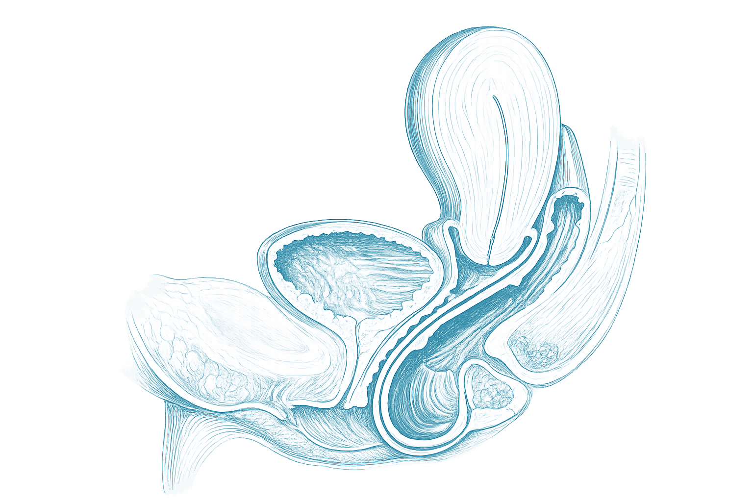 Illustration showing a rectocele bulging into the back wall of the vagina.