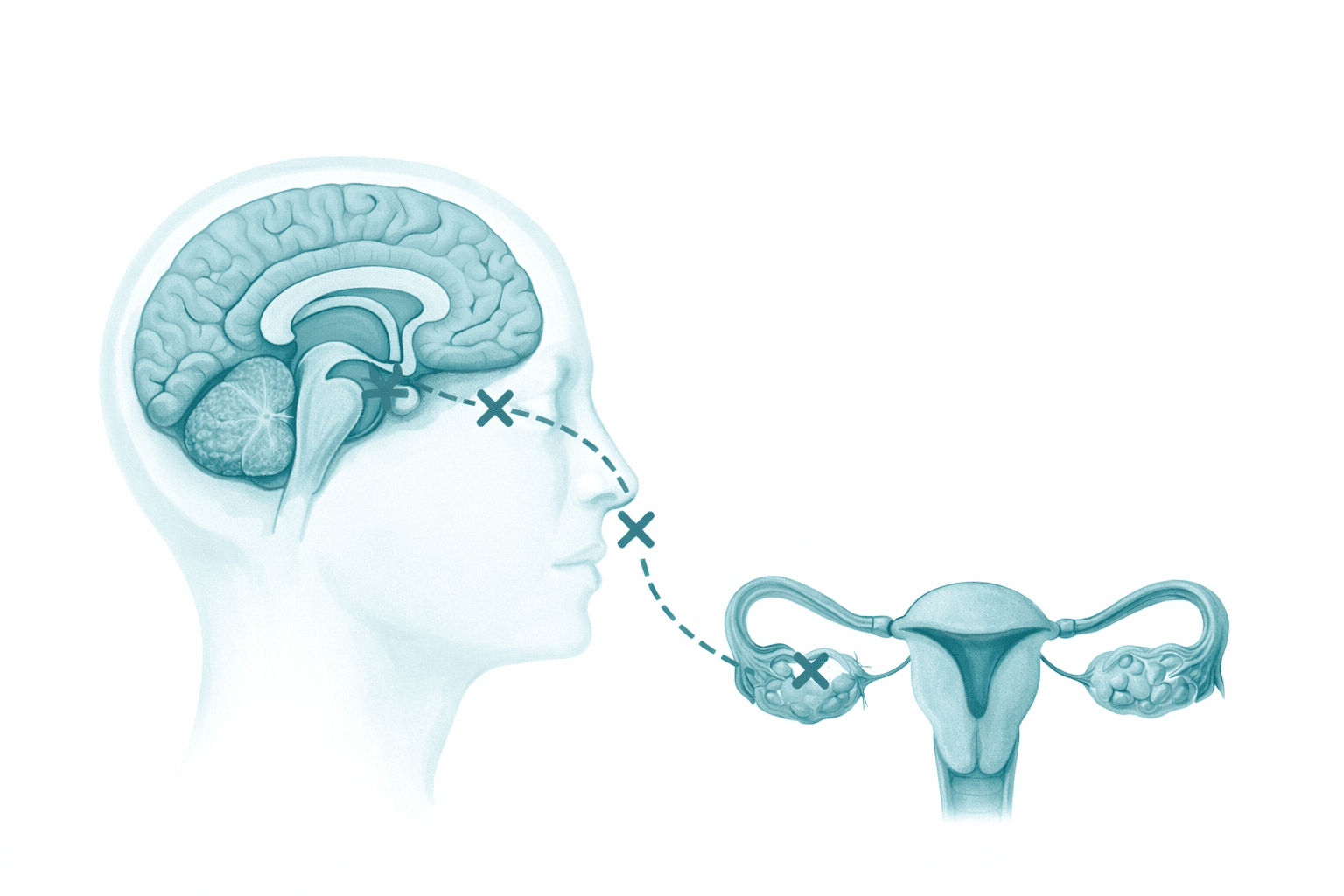 Illustration showing reduced hormone communication between brain and ovaries in functional hypothalamic amenorrhoea.