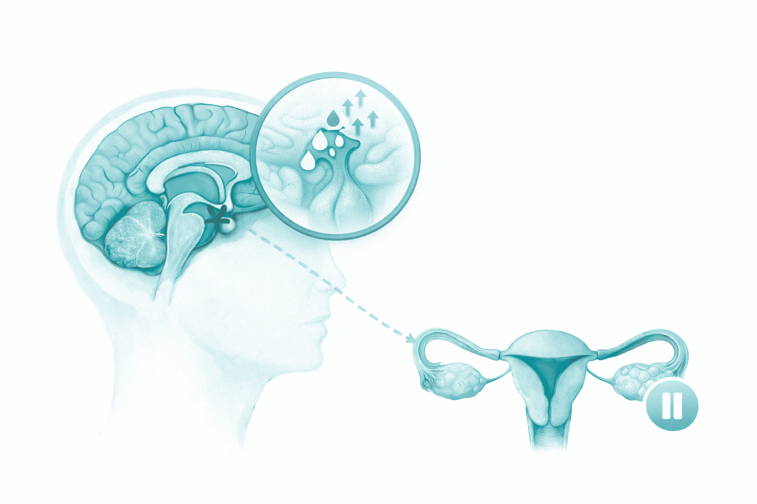 Illustration showing high prolactin signaling from the pituitary affecting ovulation and periods.