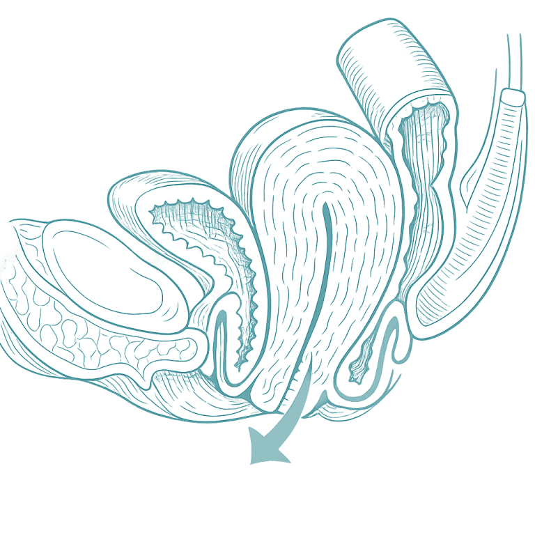 Illustration showing uterine prolapse descending into the vagina